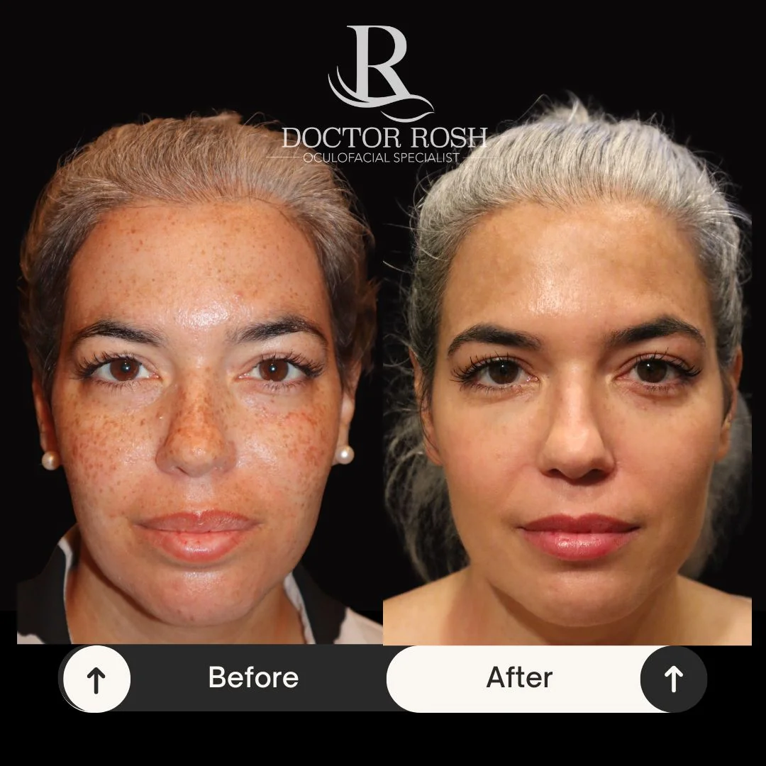 BBL/MOXI before and after - Patient 1