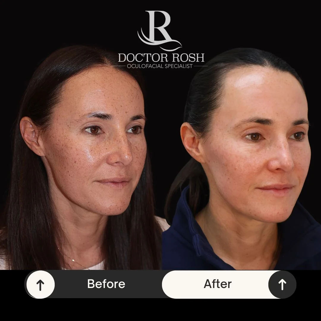 BBL/MOXI before and after - Patient 3