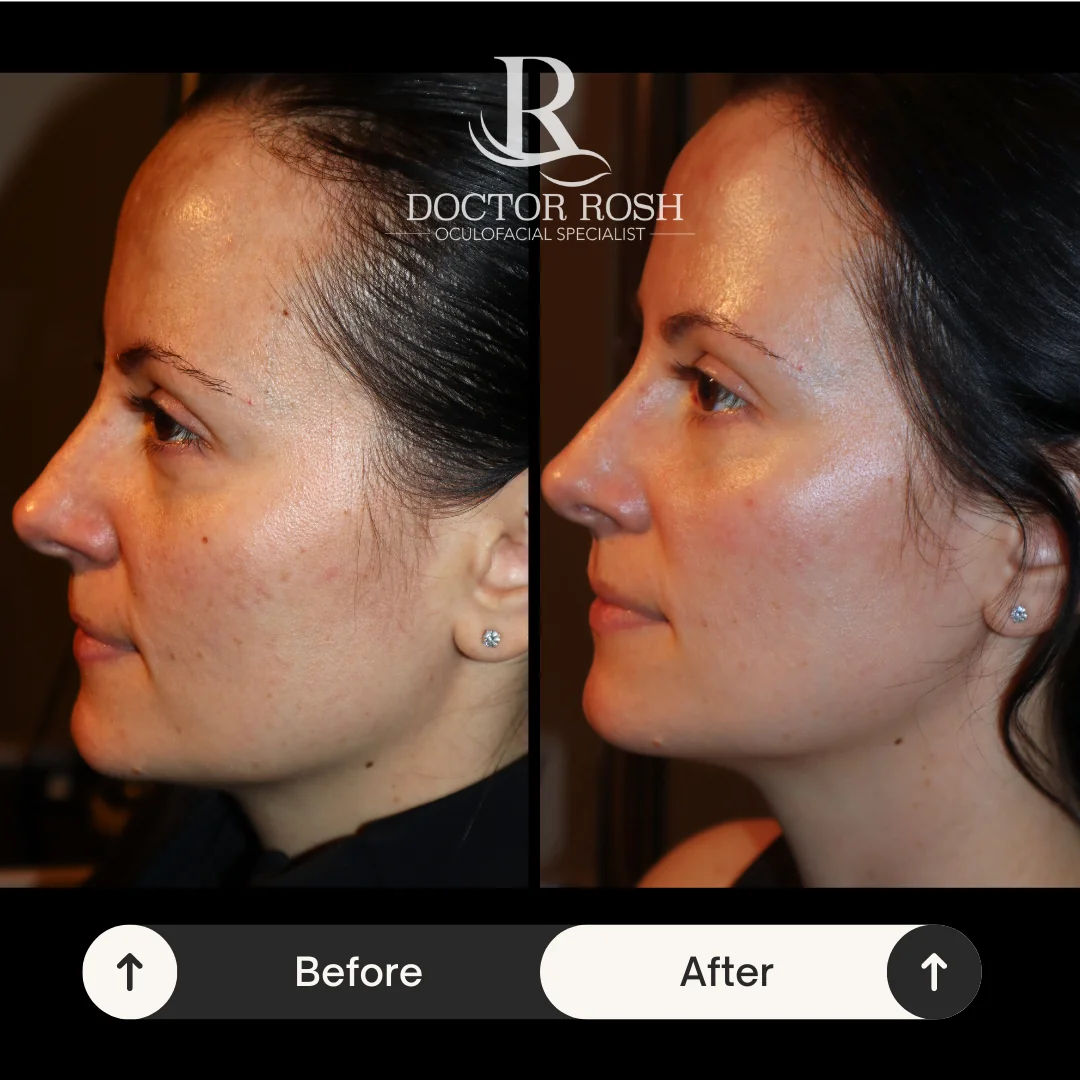 BBL/MOXI before and after - Patient 4