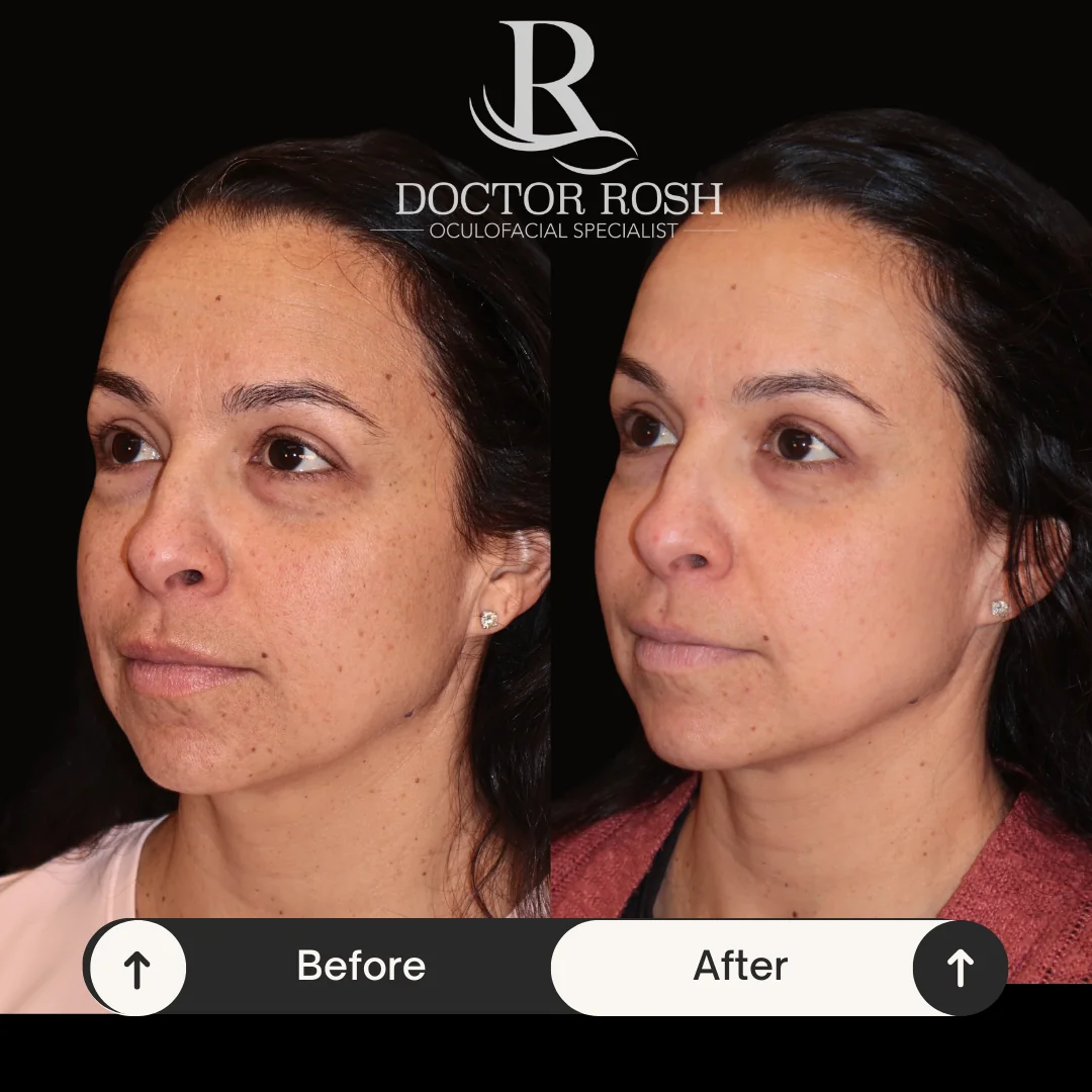 BBL/MOXI before and after - Patient 7