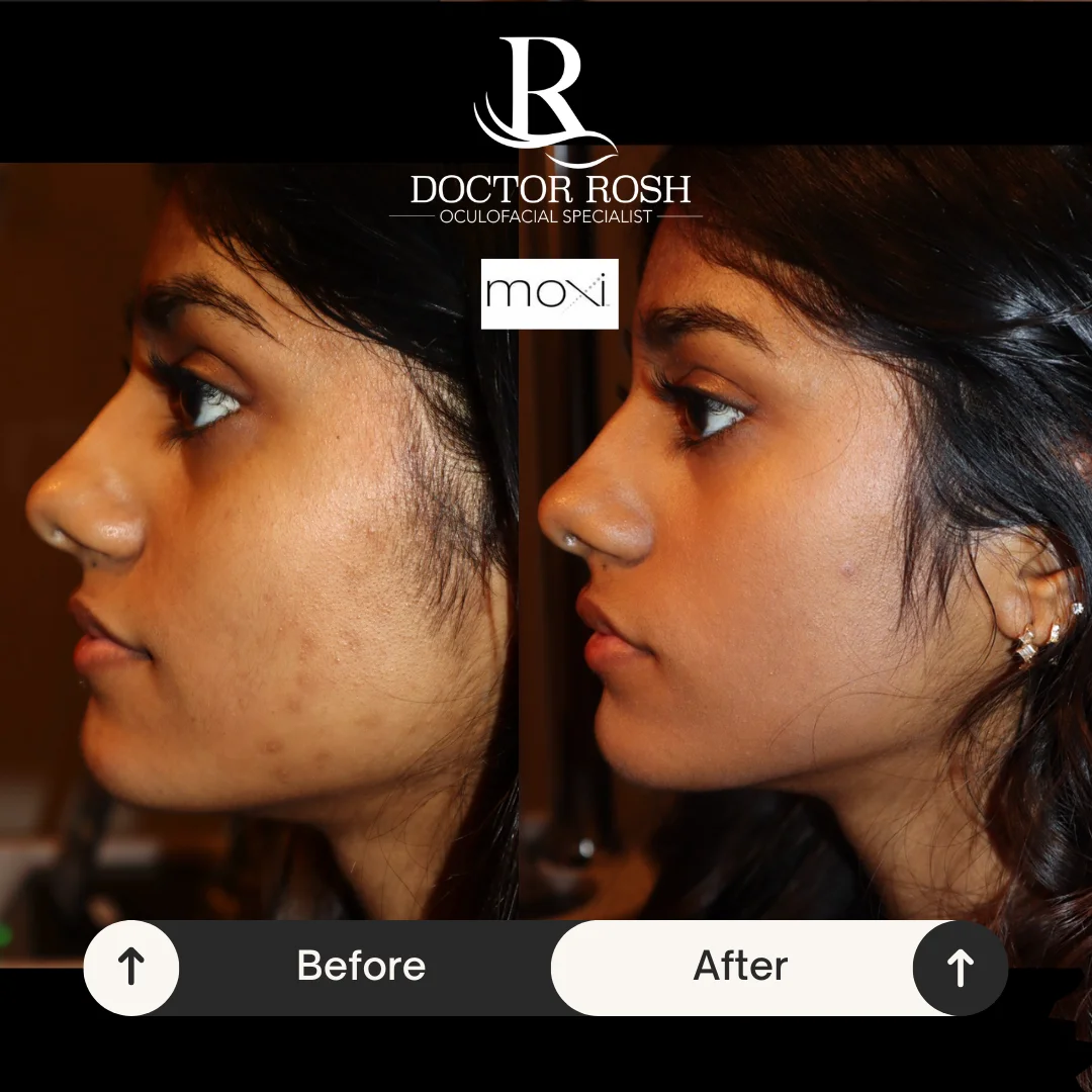 MOXI before and after - Meg side profile