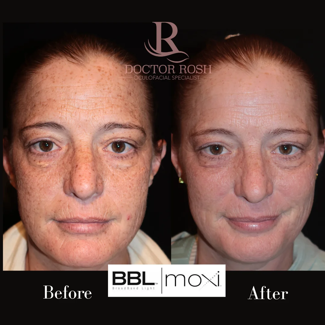 BBL/MOXI before and after - Sarah Giles front view