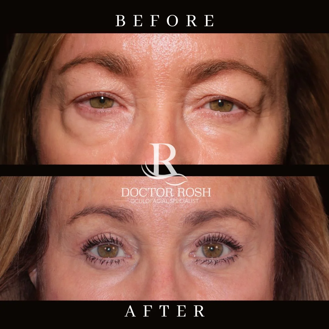 Upper blepharoplasty before and after - Abbas eye detail