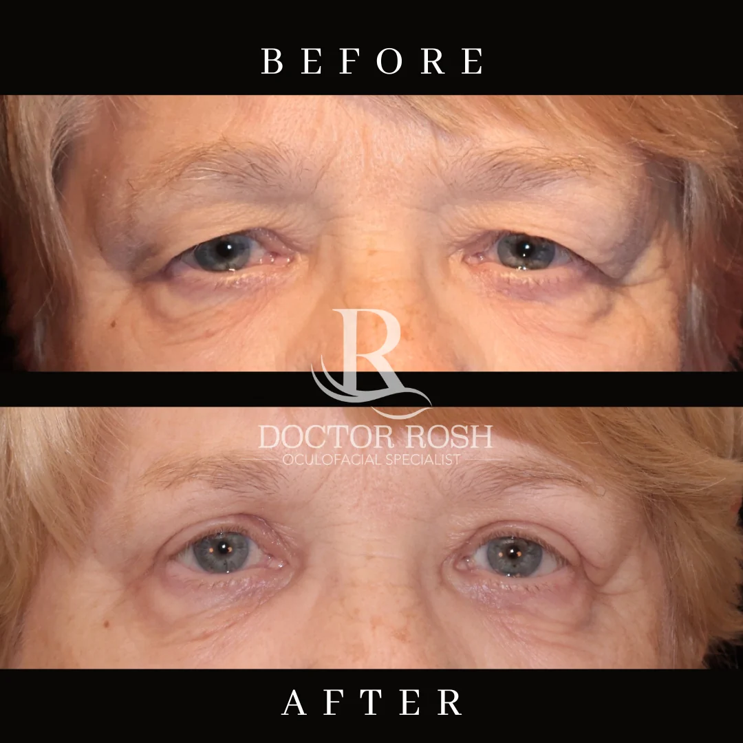 Upper blepharoplasty before and after - Gail eye detail
