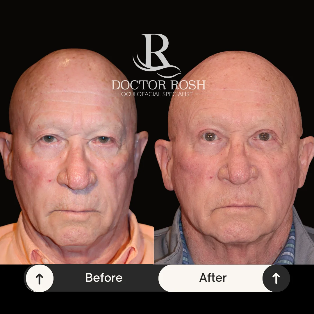 Upper blepharoplasty before and after - Kennedy full face
