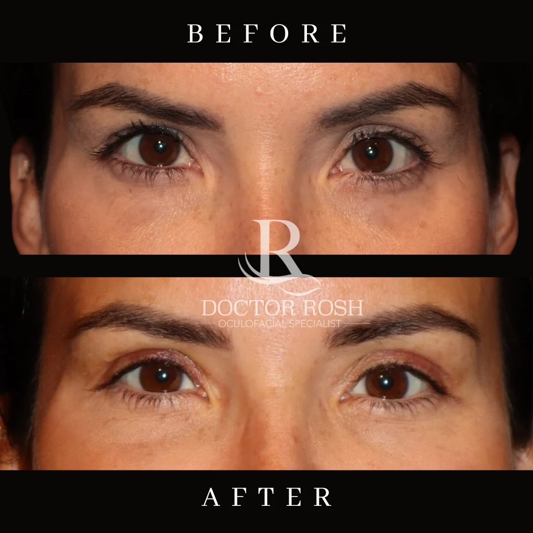 Upper blepharoplasty before and after - Ortiz eye detail