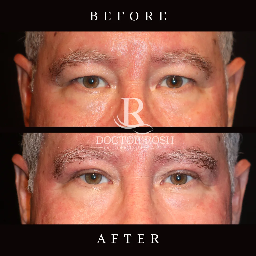 Upper blepharoplasty before and after - Patient 2