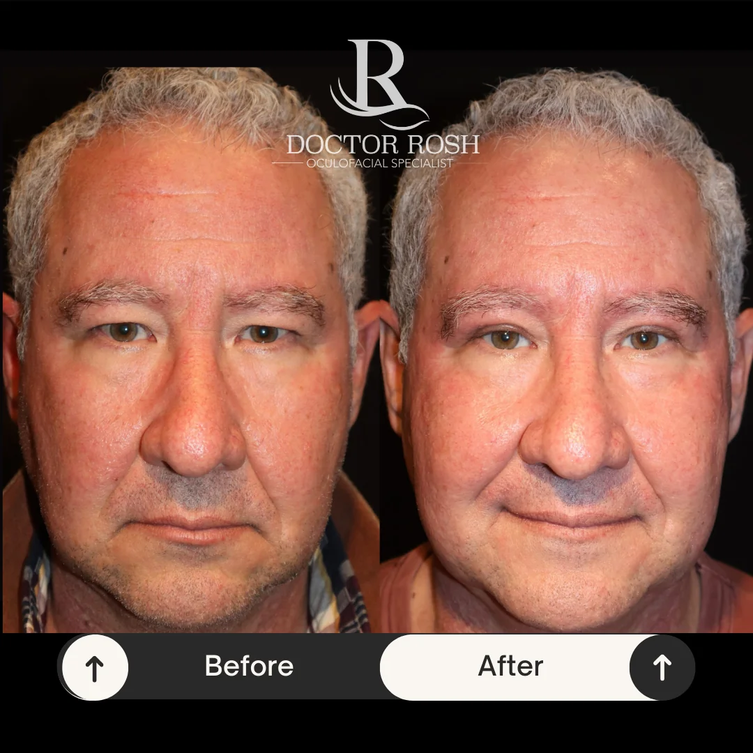 Upper blepharoplasty before and after - Patient 3
