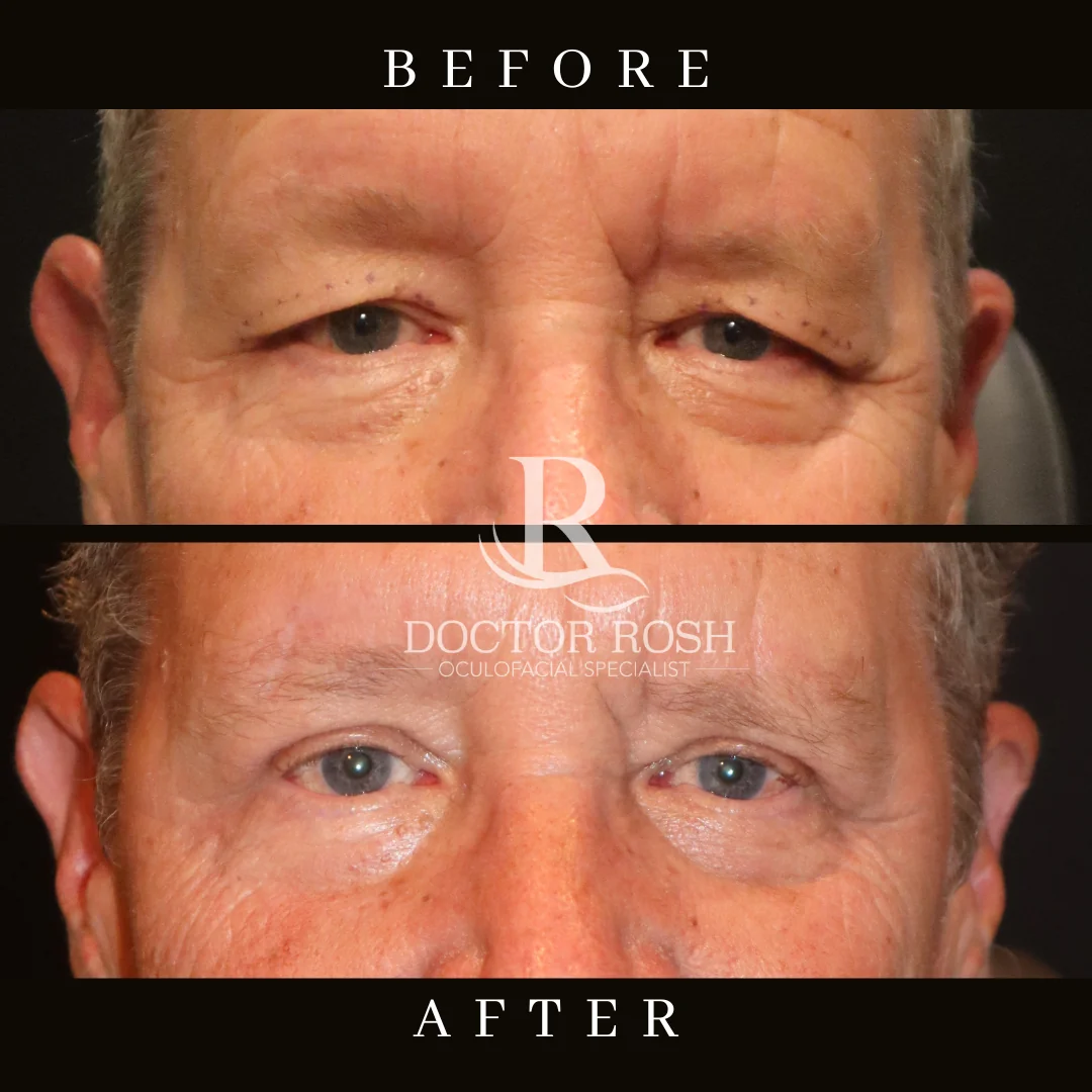 Upper blepharoplasty before and after - Patient 4