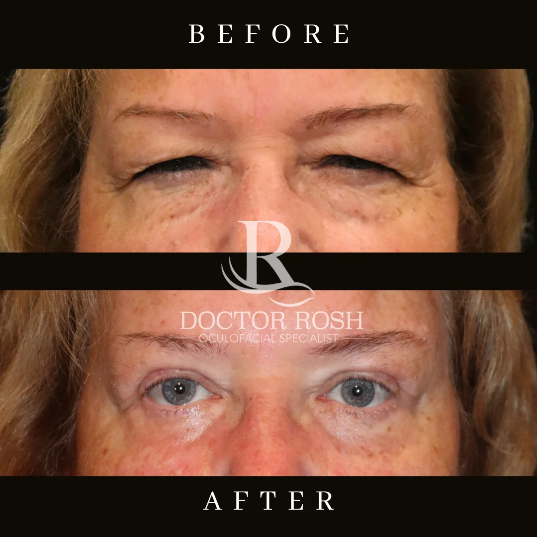 Upper blepharoplasty before and after - Patient 5
