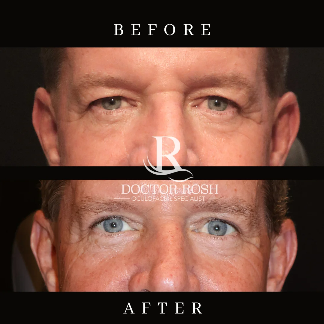 Upper blepharoplasty before and after - Tom eye detail