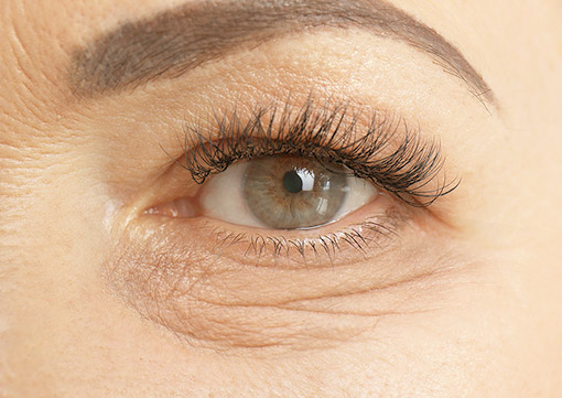 Lower Lid Blepharoplasty