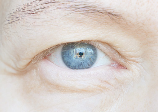 Upper Lid Blepharoplasty